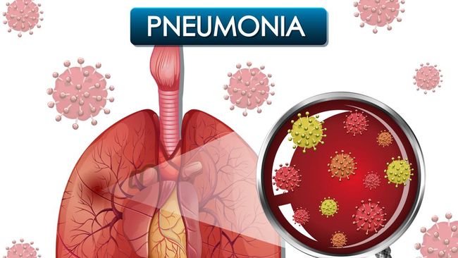 ibu-hamil-pengidap-pneumonia-bisa-menularkan-ke-janin-ini-kata-dokter_fd298f2.jpg